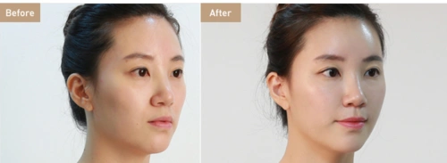 如何判断自己适不适合填充苹果肌