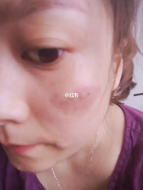 胎记激光第二天