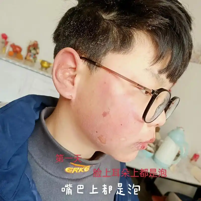 从烧住的第一天开始   都害怕儿子脸上要是留下疤了怎么办,现 - 抖音