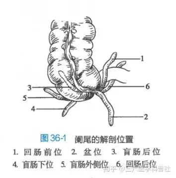(图片来源于人民卫生出版社局部解剖学第九版)最常见引起急性阑尾炎的