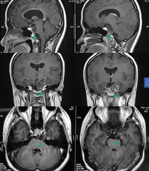 垂体瘤微创手术治疗之经鼻手术_垂体瘤_垂体瘤治疗方式 - 好大夫在线