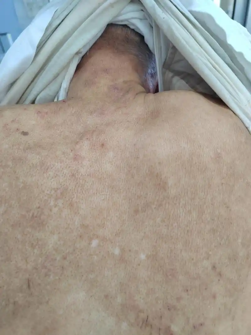 老年男性背部泛发性湿疹症状.