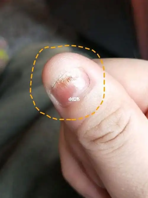 用了那么多的灰指甲产品还是这个方法管用