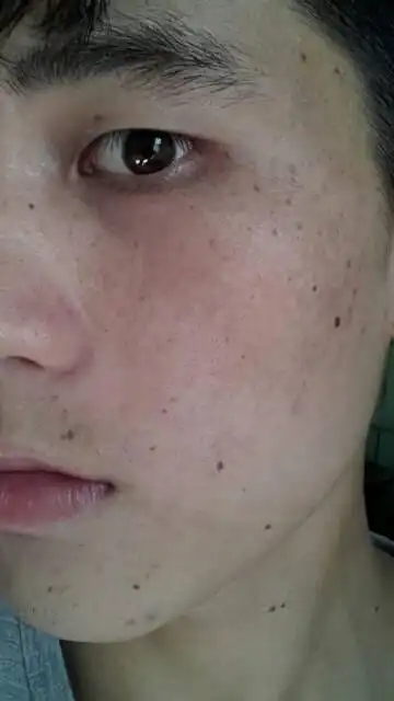 【脸部黑痣斑点】如图※我也不懂这是啥玩意,这个丑态困扰着我,以前不