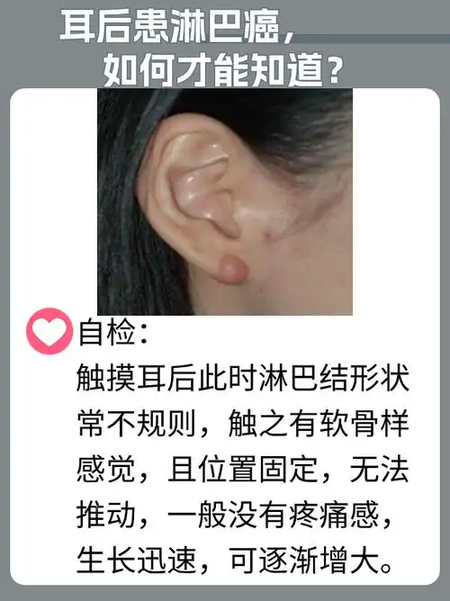 耳后患淋巴癌,如何才能知道?