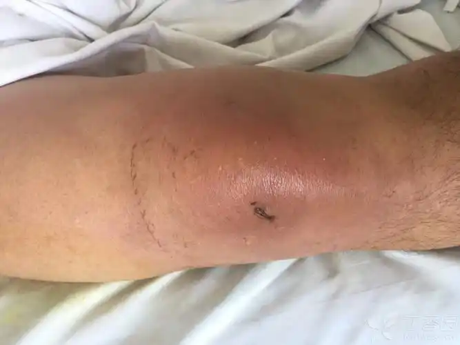 一例坏死性筋膜炎