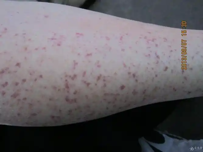过敏性紫癜