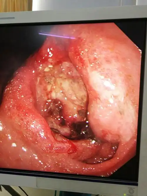 胃镜检查示:胃小弯4x5cm巨大溃疡,底部可见污苔及血痂,周边粘膜充血