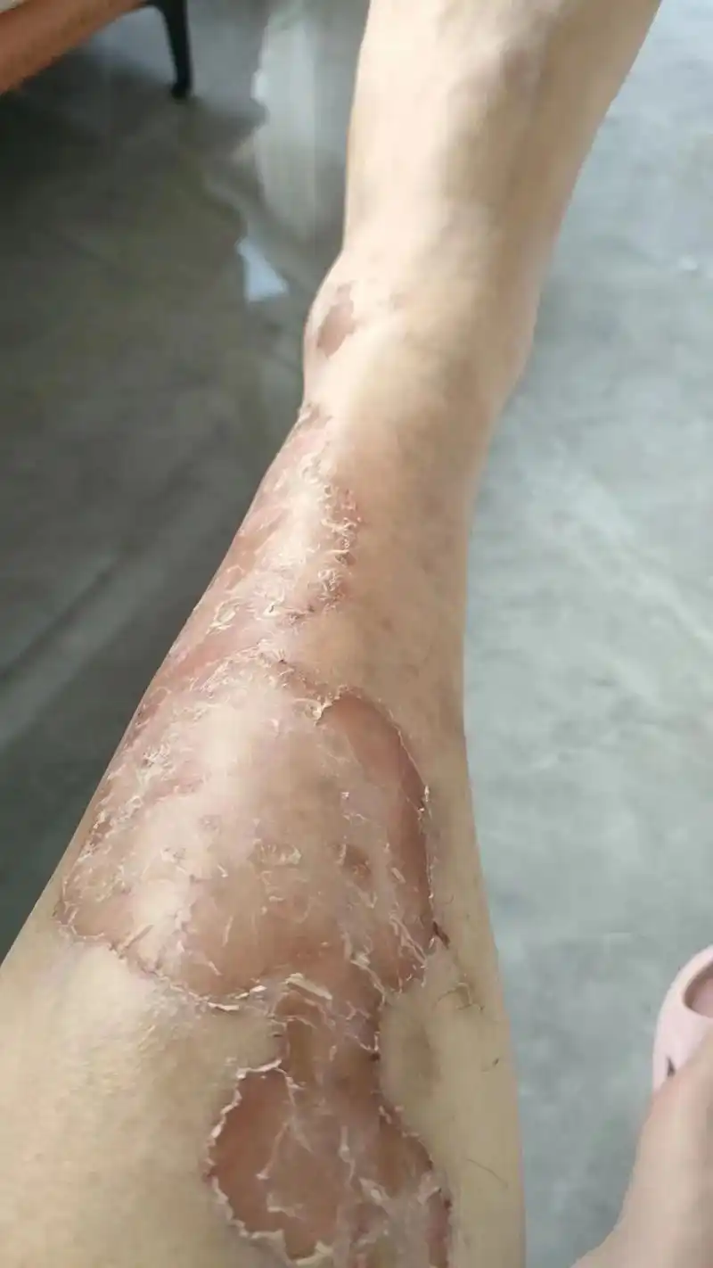 最烦心的问题!牛pi癣这个终于见轻了#皮肤管理 #这家店回头 - 抖音