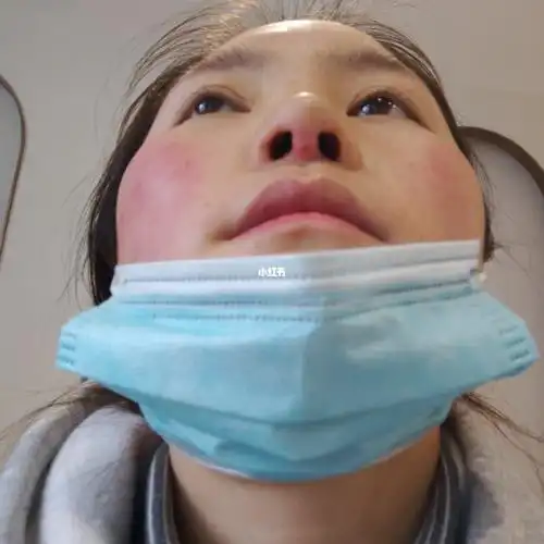 目前没发现鼻子有啥问题,比初鼻高.可能是还没恢复好.继续观察吧.