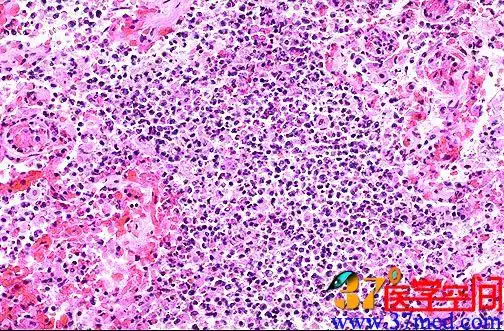 肺炎的脓肿灶高倍镜