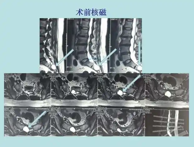 陈来照主任团队:骶管囊肿一例