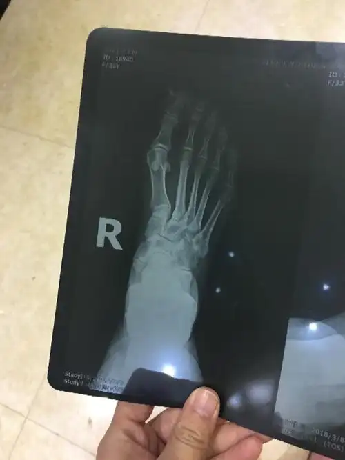 医生您好,三年前右脚崴了下,没有肿,轻微疼,我没有检查,最近拍片显示