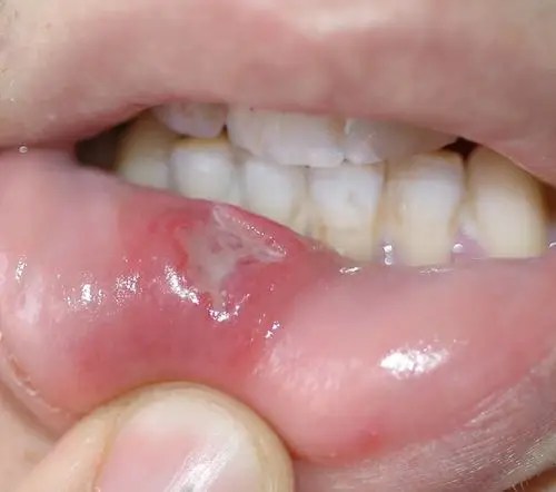 口腔炎图片 (11)_有来医生
