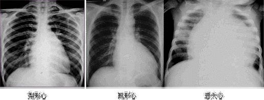 临床执业医师实践技能考试心脏增大诊断公式