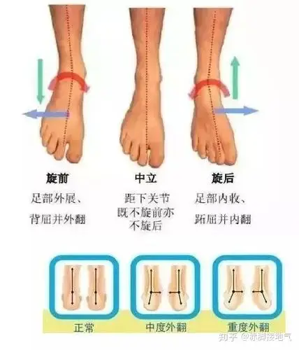 不正确地站立姿势,可能长此以往会造成足部关节的旋前或旋后.