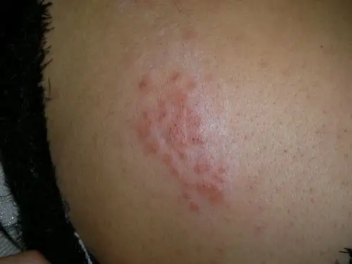 带状疱疹复发一例-----《春季皮肤病病例征集》