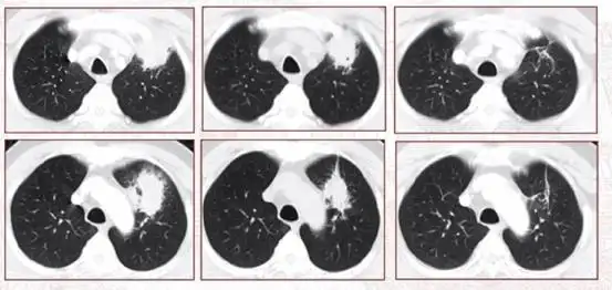 掌握四点,轻松搞定肺结核病---鉴别诊断
