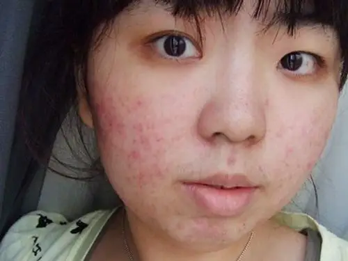 螨虫过敏症状引发结膜炎图片