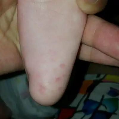孩子八个月了,今天发现足底有红点.不知道这是怎麼回事?