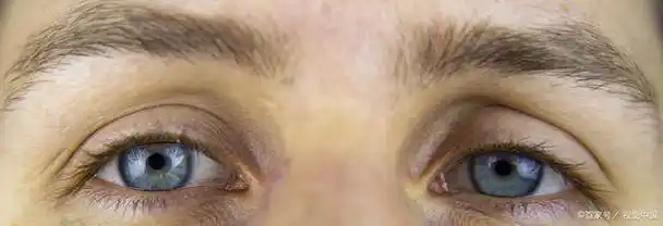 戴眼镜久了眼球突出怎么办?