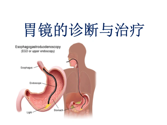 胃镜的诊断与治疗ppt课件.ppt
