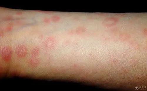 皮肤性病图谱☆有☆奖☆点☆评☆52:二期梅毒疹.
