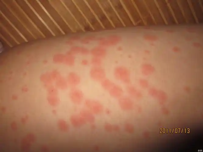 身上多发部位红斑,痒痛,帮忙看看,谢谢!