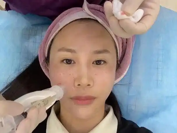 水光针术后护理不到位等于白打?