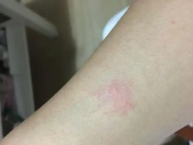 胳膊上起红疹是什么呀