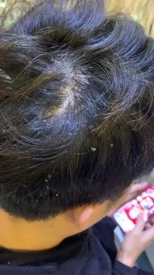 这种头皮屑我们称之为银屑病,一般长达10年以上,是会越来越严重.