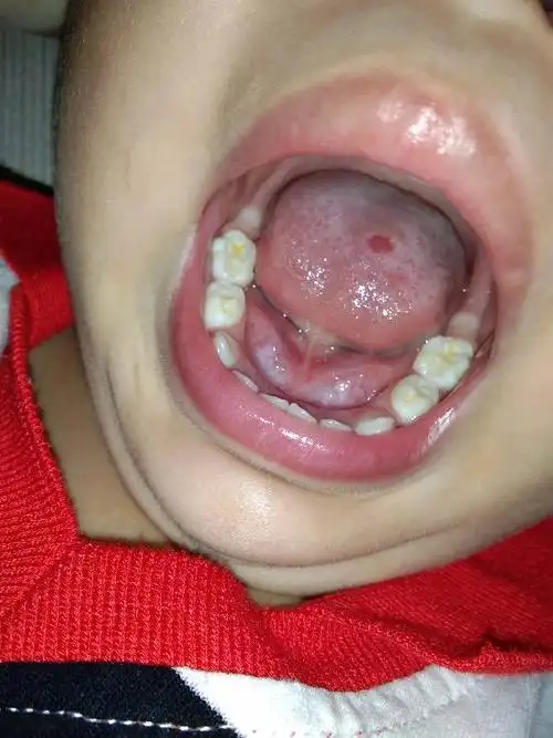 小孩2岁半,舌头上有个红色的点