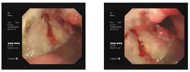 85%是中晚期!难道胃癌来临,就没有任何征兆?|胃镜|出血|症状_网易订阅