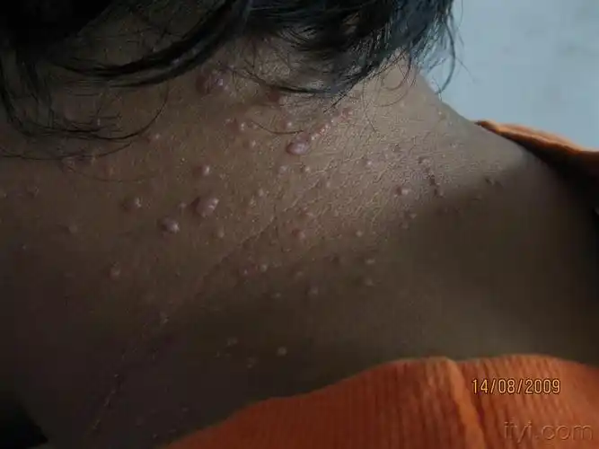 楼主上挺2009-08-15 22:57:03   某男,28岁,颈部出皮疹2月余,时有微痒