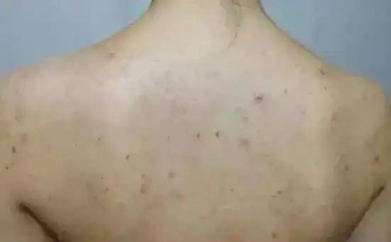 二,病因: 毛囊炎是由毛囊部位因细菌感染而引起的细菌感染性疾病,它的