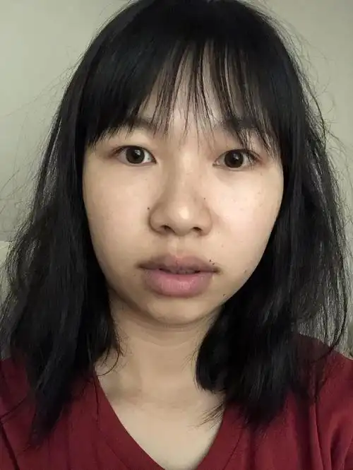 姐妹们来帮我看看是骨性还是牙性.戴牙套能改变嘴凸吗?