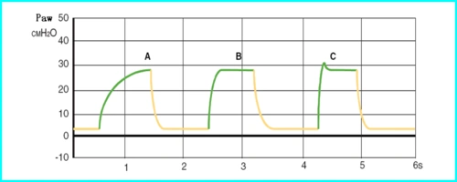 呼吸机常见波形 - 知乎