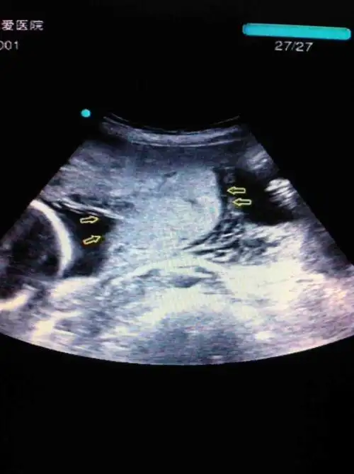 典型轮状胎盘 - 超声医学讨论版 - 爱爱医医学论坛 - 爱爱医医学网