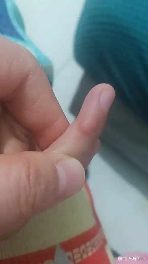 孩子手上长了个这玩意儿,不痛不痒.谁知道这是什么?需要治疗吗?