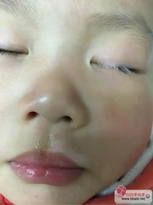 感觉小孩的嘴唇颜色两边有点不一样,如果嘴唇变白了,会不会恢复?