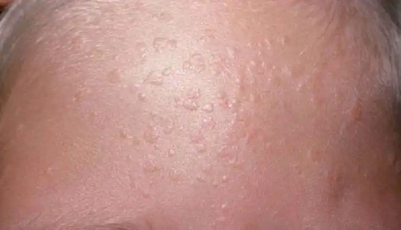 疣_陈宴_副主任医师_爱问健康