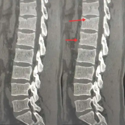 患者,男性,31岁,外伤后腰背部疼痛,ct检查显示t12椎体骨折,l1椎体疑似