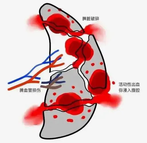 脾脏结构很特殊,一旦遭受暴力,即便是很小的裂口,常常会导致出血不止