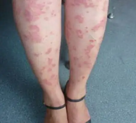 牛皮癣会传染爱人吗