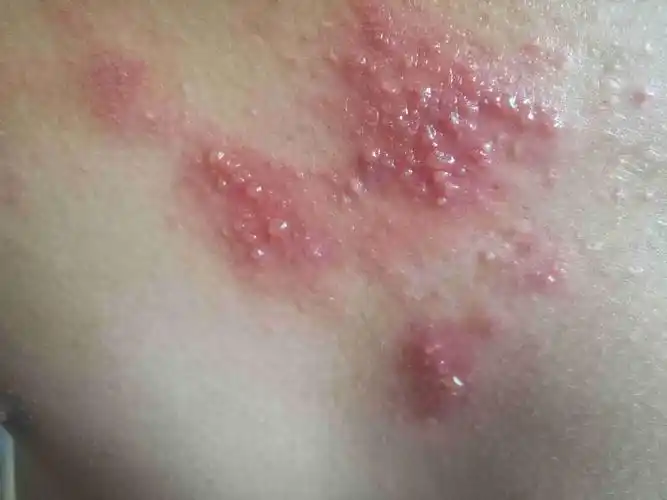 得了带状疱疹,今天是第四天,吃了三天的药了,耳朵