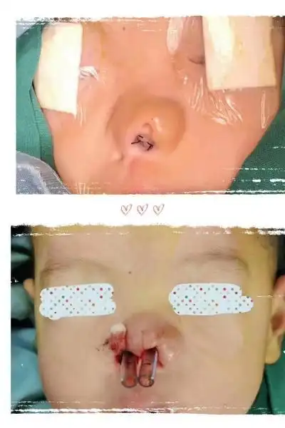 儿童医院为重度鼻畸形宝宝打开呼吸通道