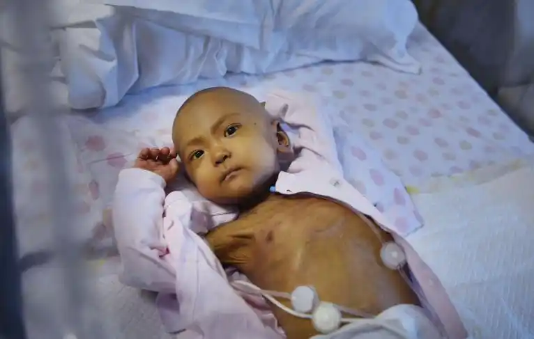 小女孩饿得骨瘦如柴,看哭无数网友,捐百万元为其救命