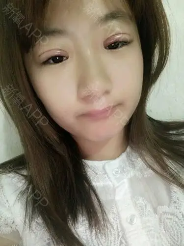 早上起来明显眼睛肿的严重了 不过没有那么疼了 只有美瞳线闭眼睛的