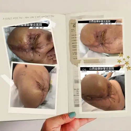 术后脂肪液化!被征服了!