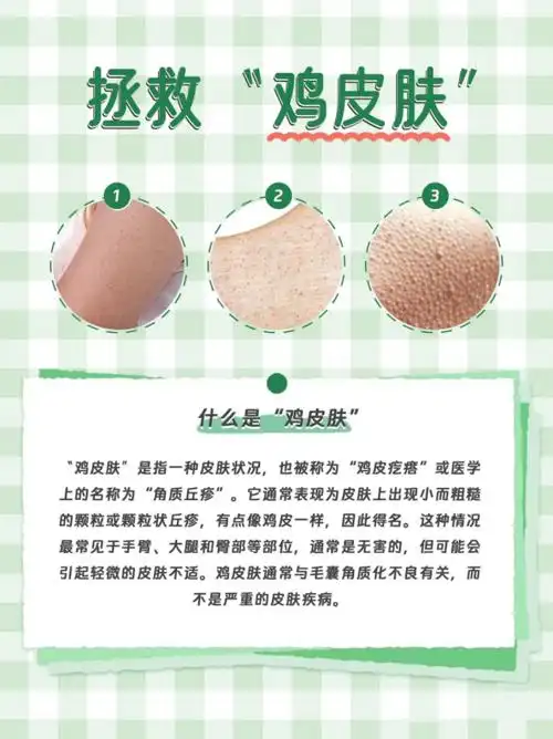 胳膊上长了密密麻麻的小疙瘩,大概率是鸡皮肤!